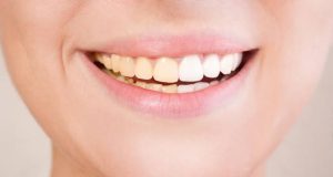 Memutihkan gigi Kuning