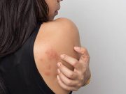 Tips Cegah dan Solusi Biang Keringat, Ruam Kulit Akibat Cuaca Panas Biang keringat