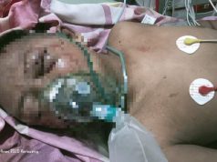 Anak Disabilitas karawang